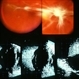 Pre-Retinal Fibrous Proliferative Membrane